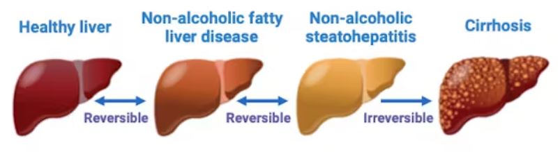 Non-alcoholic fatty liver and steatohepatitis are reversible. Cirrhosis is irreversible.